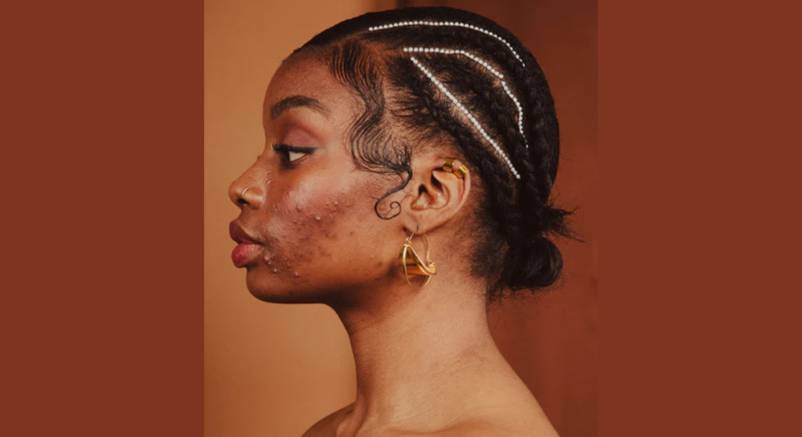 Acne on brown skin lady